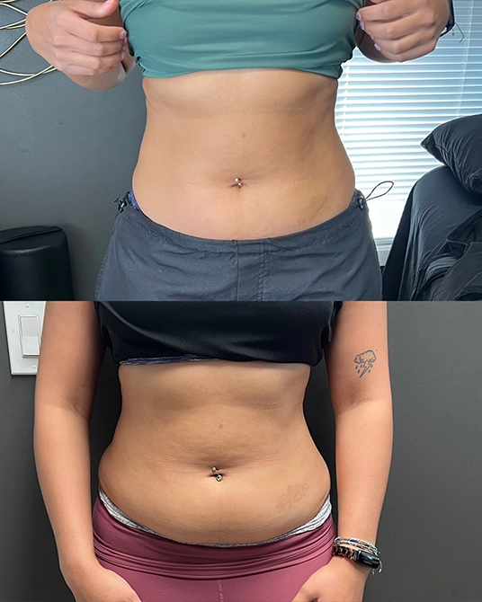 Cryoskin Body Contouring