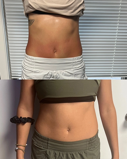 Cryoskin Body Contouring