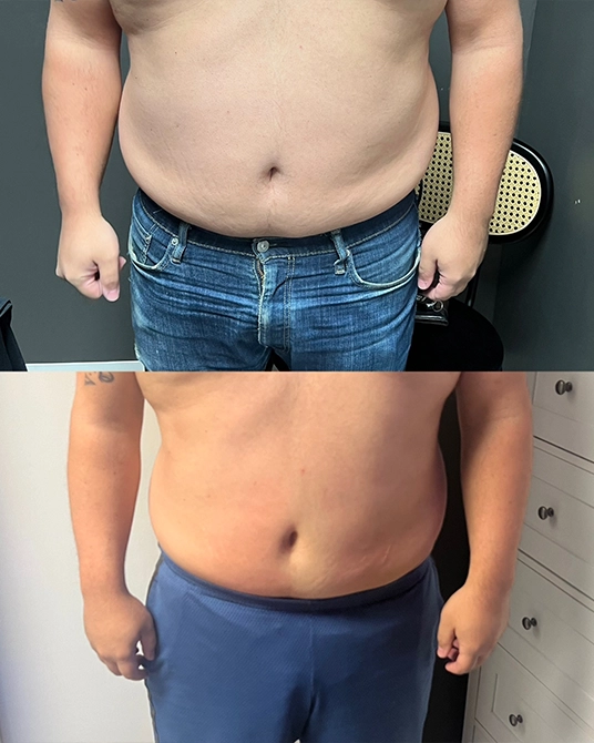 Cryoskin Body Contouring