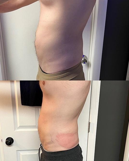 Cryoskin Body Contouring