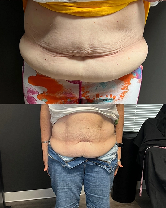 Cryoskin Body Contouring