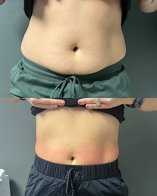 Cryoskin Body Contouring