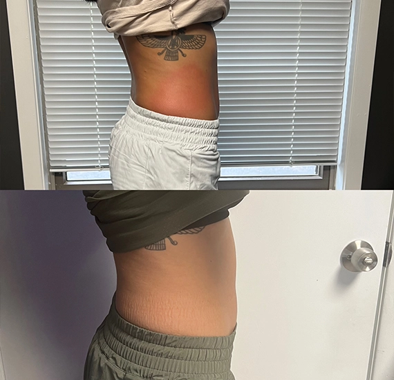 Cryoskin Body Contouring